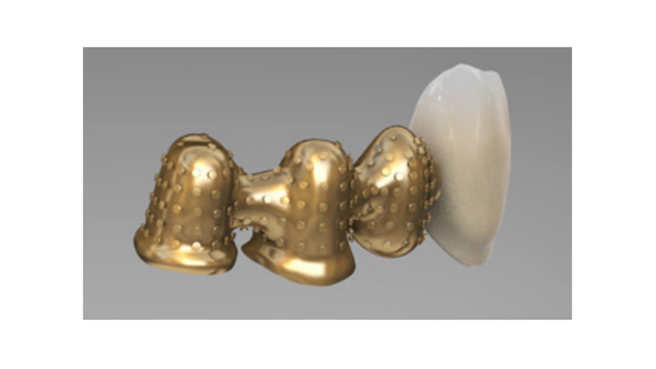 Fațetare cu suport metalic