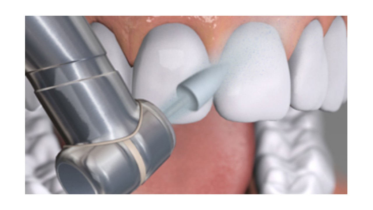 Materiale de restaurare