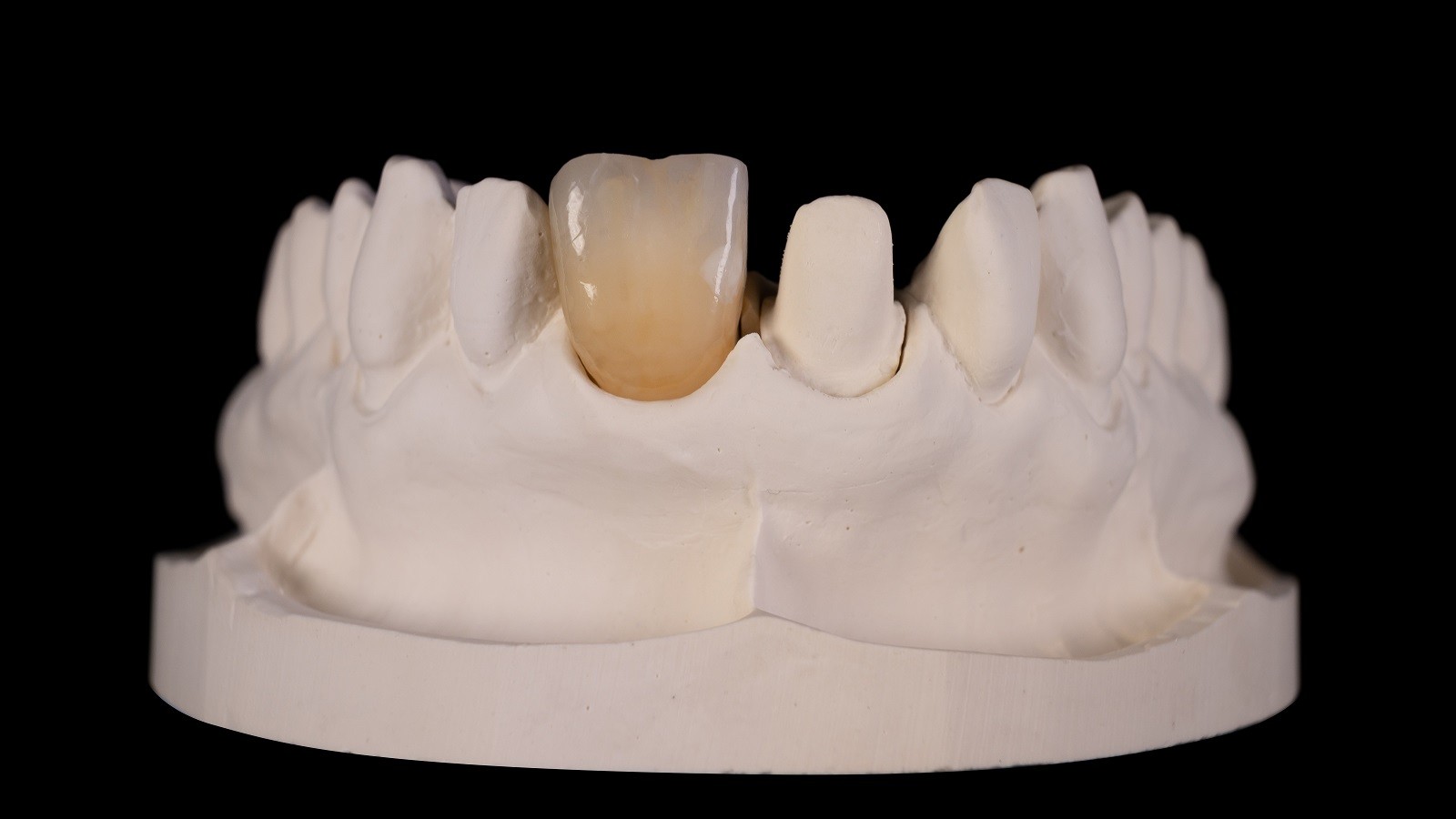 Accentuarea fisurilor de smalț și a petelor cretoase